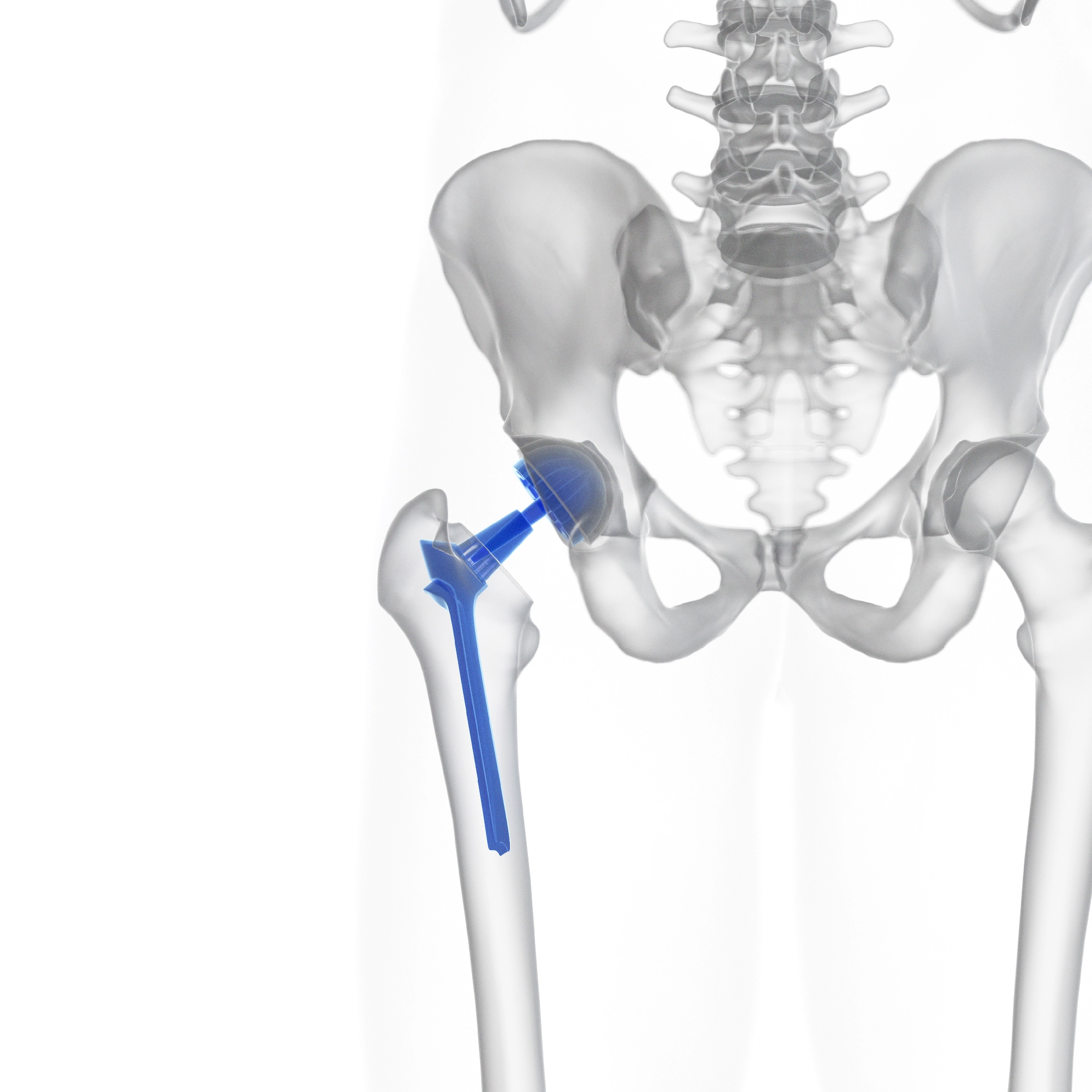 Kalça Protezi Ameliyatı